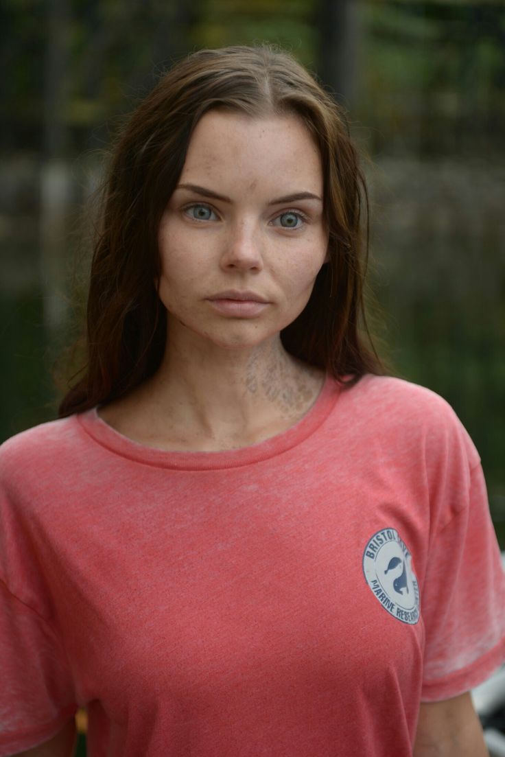 Eline Powell plastic surgery